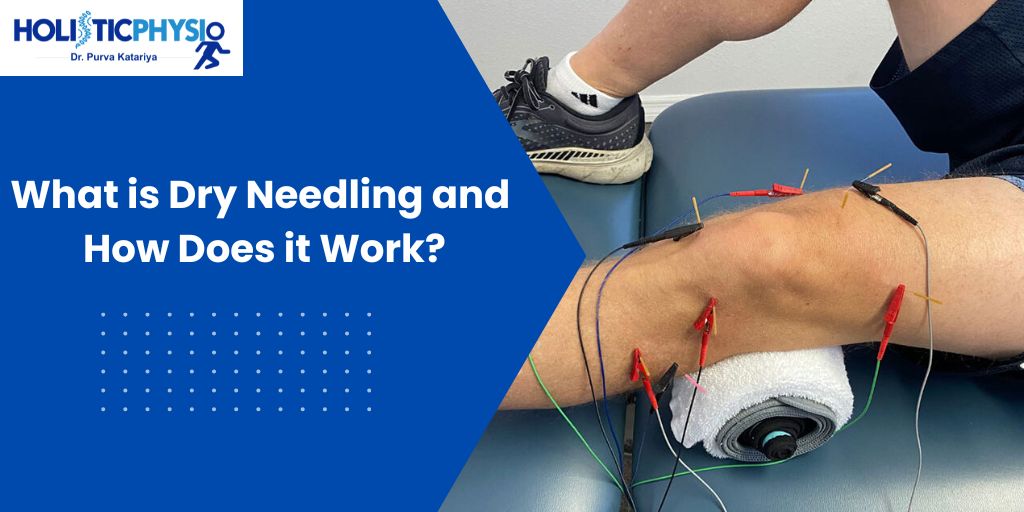 What is Dry Needling and How Does it Work?
