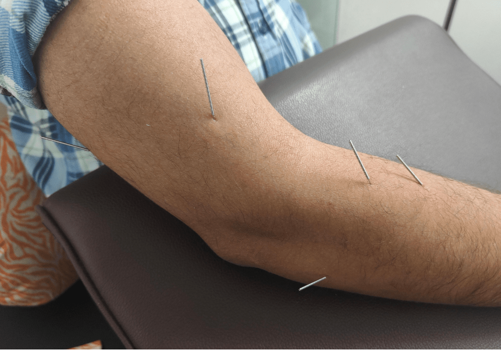 Dry Needling