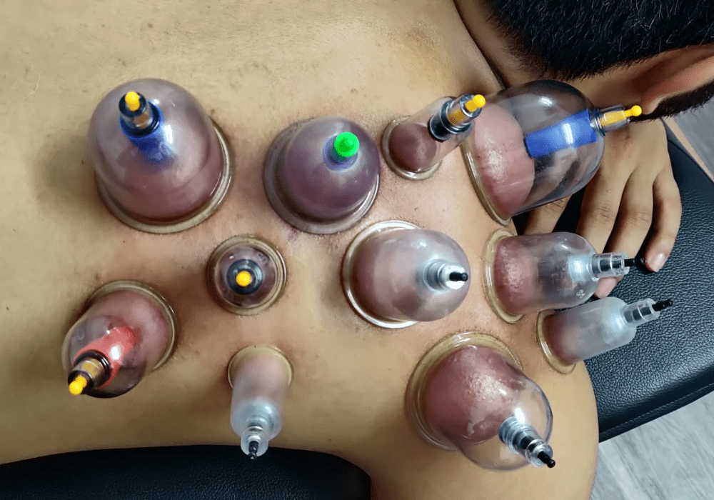 Cupping Treatment